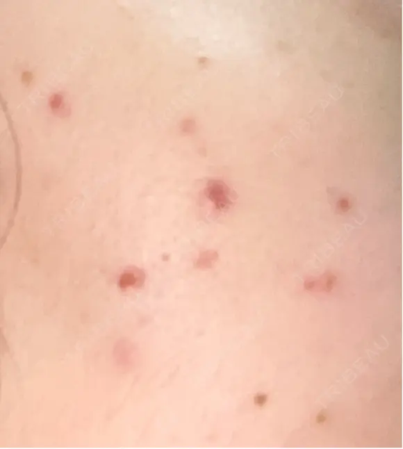 その他（肌） / ポテンツァ ルラ美容クリニック 郡山院 DAY 7 メイン用