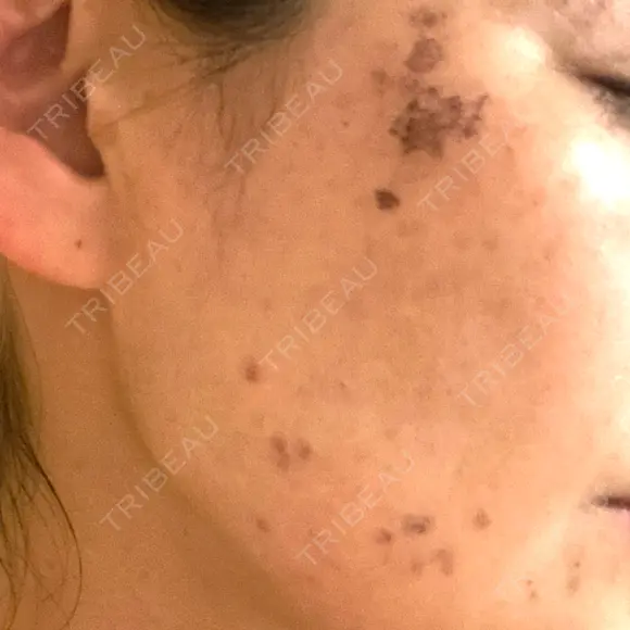 シミ取りレーザー S-Laboクリニック 渋谷院 DAY 1 メイン用