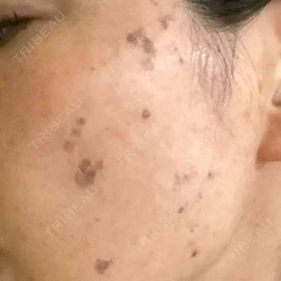 シミ取りレーザー S-Laboクリニック 渋谷院 DAY 1 メイン用