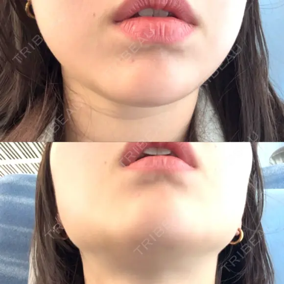 ハイフ（顔） / LDM・インテンスウルトラ 美容皮膚科ティファクリニック 新宿東口 AFTER メイン用