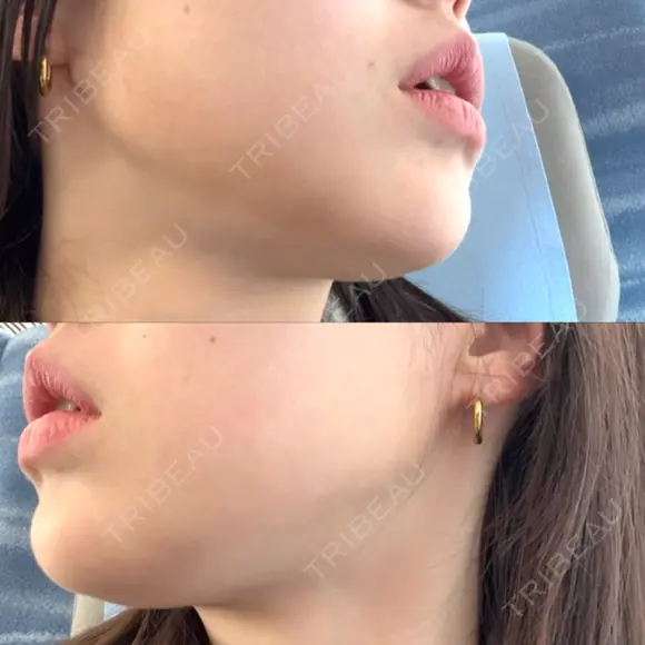 ハイフ（顔） / LDM・インテンスウルトラ 美容皮膚科ティファクリニック 新宿東口 DAY 3 メイン用