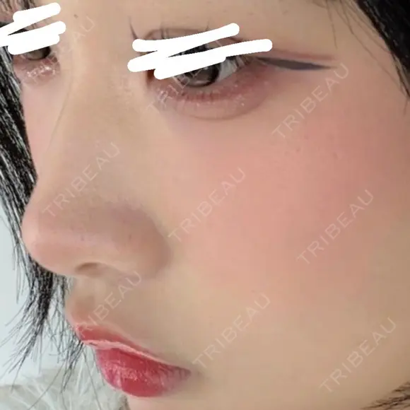 ヒアルロン酸注入（涙袋） / ヒアルロン酸注入（鼻） / ヒアルロン酸注入（あご） / ボトックス（エラ・小顔） / ヒアルロン酸注入（唇） / ヒアルロン酸注入（頬） HAAB×DREAM BEAUTY CLINIC 大阪梅田院 AFTER メイン用