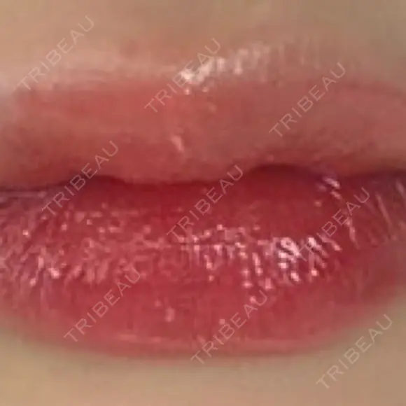 ヒアルロン酸注入（涙袋） / ヒアルロン酸注入（鼻） / ヒアルロン酸注入（あご） / ボトックス（エラ・小顔） / ヒアルロン酸注入（唇） / ヒアルロン酸注入（頬） HAAB×DREAM BEAUTY CLINIC 大阪梅田院 DAY 18 メイン用