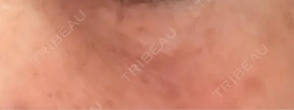 ほくろ・いぼ切除（肌） ルラ美容クリニック 横浜院 DAY 6 メイン用