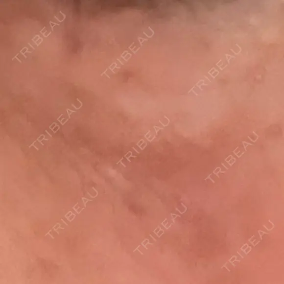 ほくろ・いぼ切除（肌） ルラ美容クリニック 横浜院 AFTER メイン用