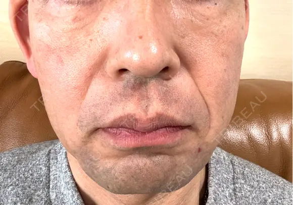RF（高周波）たるみ治療 plume clinic AFTER メイン用