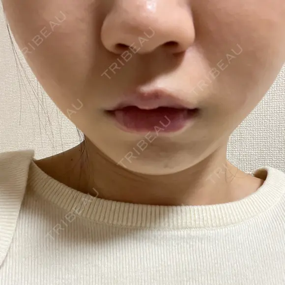 イオン導入 / ルメッカ やさしい美容皮膚科・皮フ科　秋葉原院 AFTER メイン用