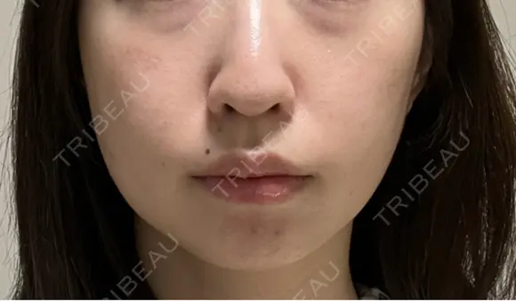 美肌レーザー / シミ取りレーザー / 美白レーザー / エレクトロポレーション / 毛穴洗浄（ハイドラフェイシャルなど） / ピコレーザートーニング（美白・肝斑） / フラクショナルレーザー（毛穴・ニキビ跡） / レーザートーニング（美白・肝斑） Fellez Clinic【フェルズクリニック】 AFTER メイン用