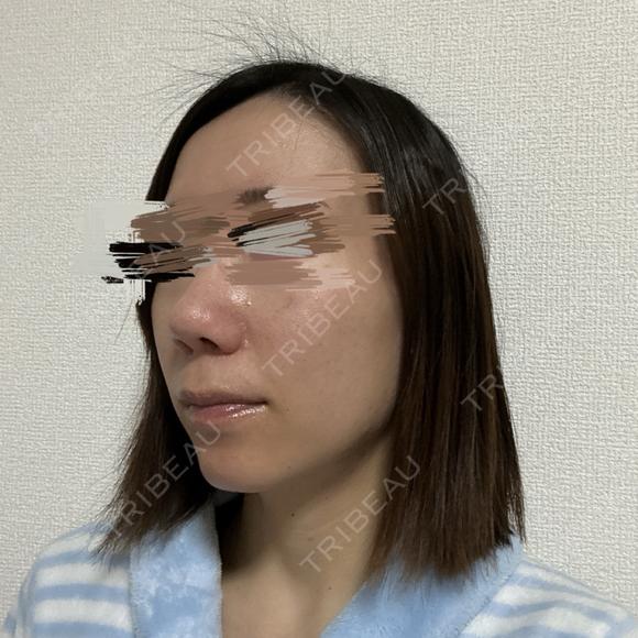 その他（鼻） / 軟骨移植 / ワシ鼻修正・ハンプ切除 / 真皮移植 LUHO（ルホ）美容外科 DAY 152 メイン用