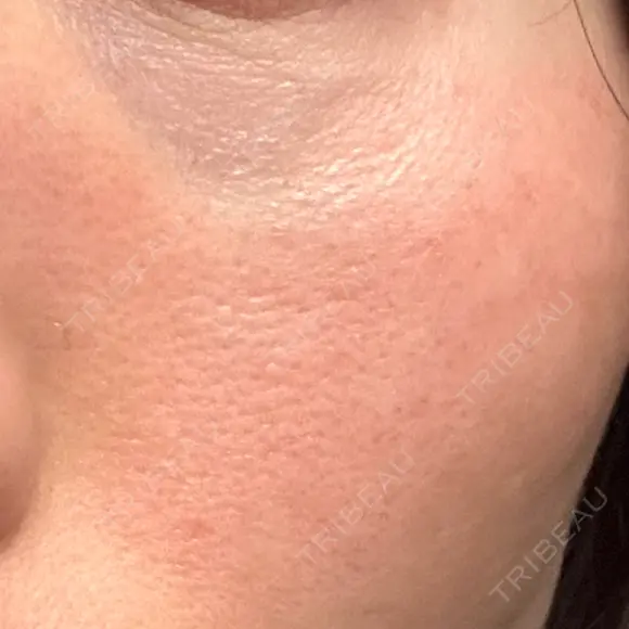 美肌レーザー LEX BEAUTY CLINIC AFTER メイン用