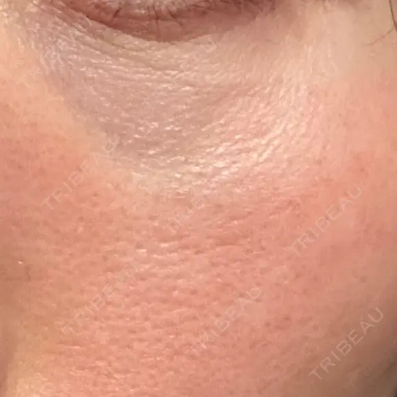 その他（目元） 品川スキンクリニック広島院 DAY 3 メイン用