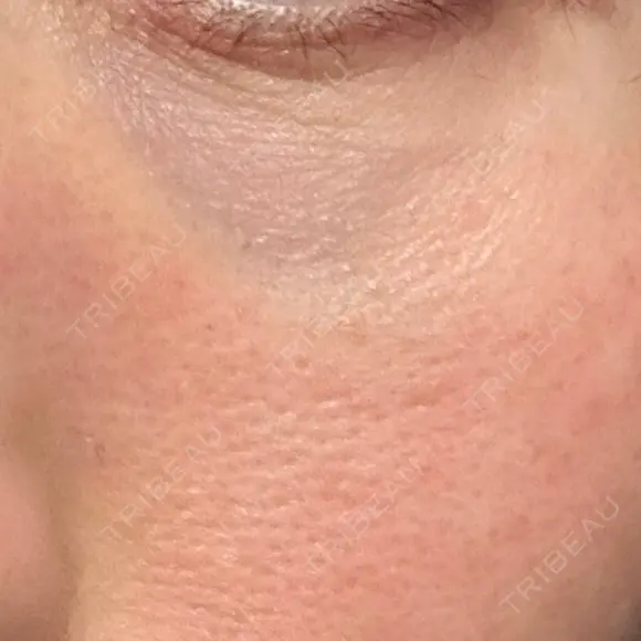 その他（目元） 品川スキンクリニック広島院 DAY 4 メイン用