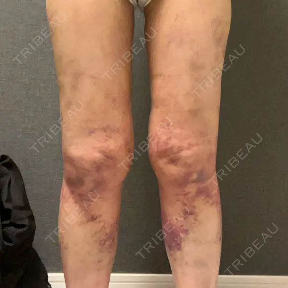 脂肪吸引（脚） GAYA body design clinic AFTER メイン用