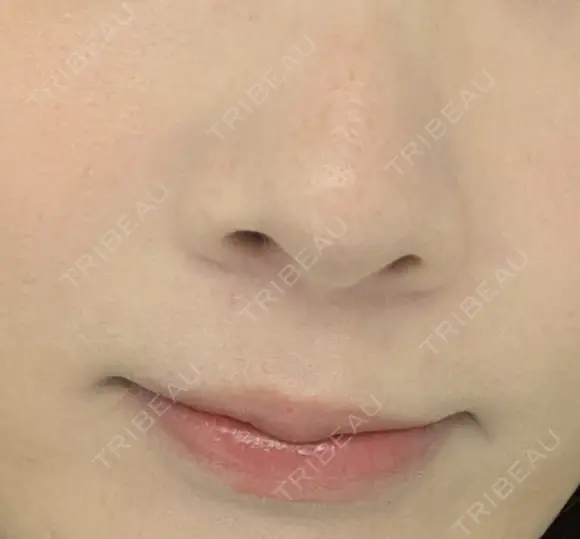 真皮移植 / 鼻翼基部形成（貴族手術） EMMO FACE CLINIC 東京三田院 AFTER メイン用