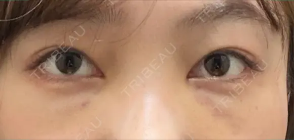 クマ治療 / 下まぶたたるみ取り / 下まぶたの脂肪取り 新宿美容外科ネビュラクリニック DAY 5 メイン用