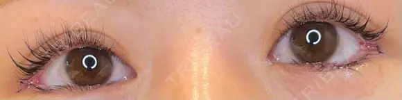 目尻切開 / タレ目形成・グラマラスライン（埋没） LOUIS CLINIC 二子玉川院【ルイクリニック】 DAY 0 メイン用