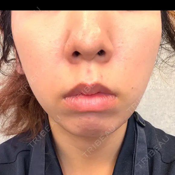 ルメッカ ルラ美容クリニック 岡山院 AFTER メイン用