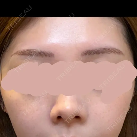 アートメイク（眉） G MEDICAL ART クリニック 新宿院 AFTER メイン用