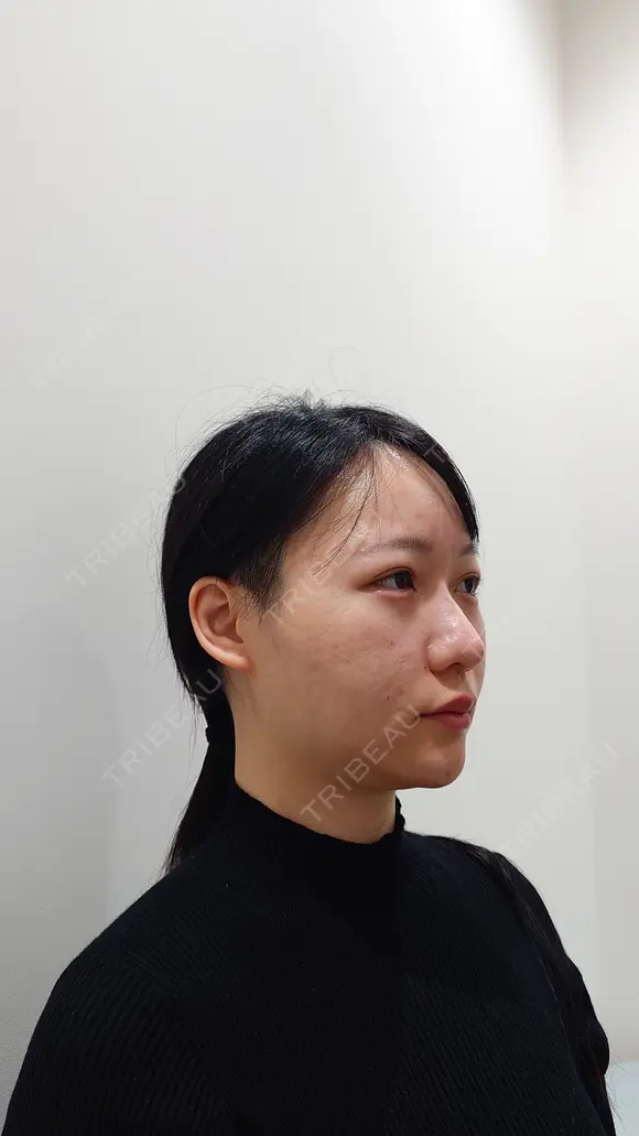 ヒアルロン酸注入（涙袋） / ヒアルロン酸注入（鼻） / ボトックス（あご） / ヒアルロン酸注入（あご） HAAB×DREAM BEAUTY CLINIC 大阪梅田院 DAY 0 メイン用