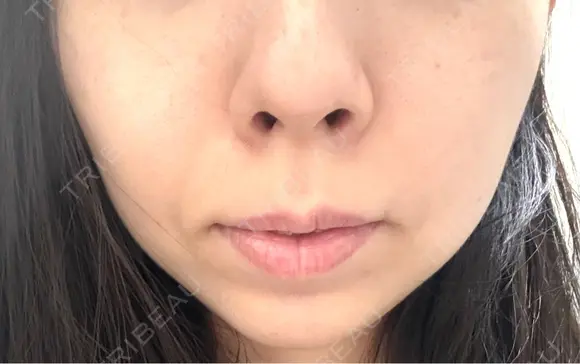 チタニウムリフト 博多美容外科/美容皮膚科 ビラビューティークリニック DAY 3 メイン用