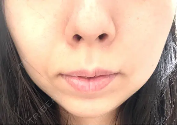 チタニウムリフト 博多美容外科/美容皮膚科 ビラビューティークリニック AFTER メイン用