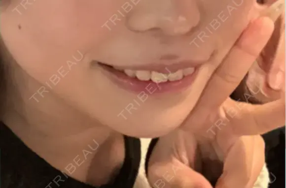 糸リフト / 脂肪吸引（顔） Wing clinic 豊中駅前院 AFTER メイン用