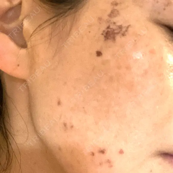 シミ取りレーザー S-Laboクリニック 渋谷院 DAY 3 メイン用