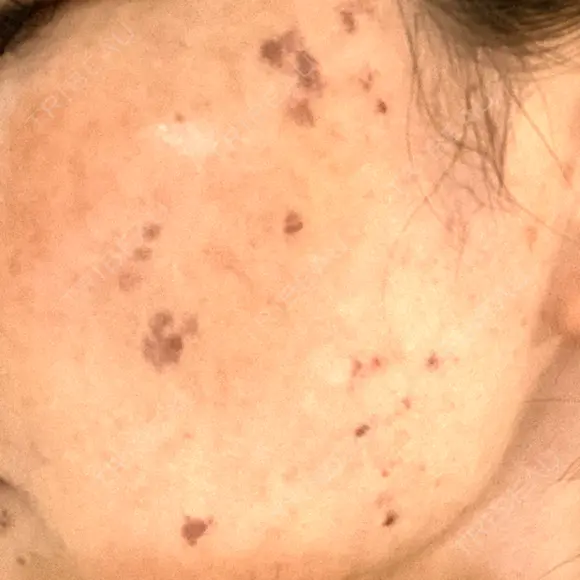 シミ取りレーザー S-Laboクリニック 渋谷院 DAY 3 メイン用