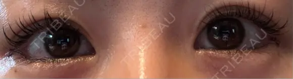 目尻切開 / タレ目形成・グラマラスライン（埋没） LOUIS CLINIC 二子玉川院【ルイクリニック】 DAY 1 メイン用