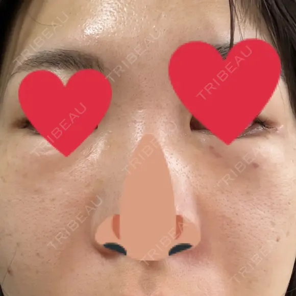 リジュラン Natural Skin Clinic 自由ヶ丘院 DAY 1 メイン用