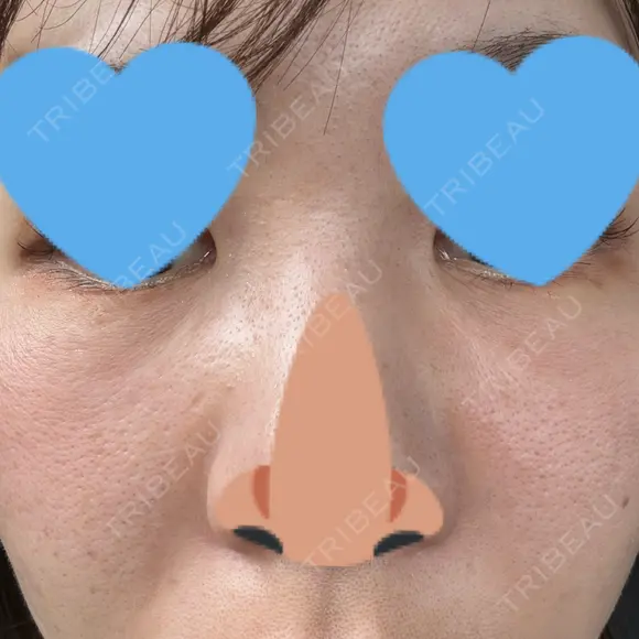 リジュラン Natural Skin Clinic 自由ヶ丘院 AFTER メイン用