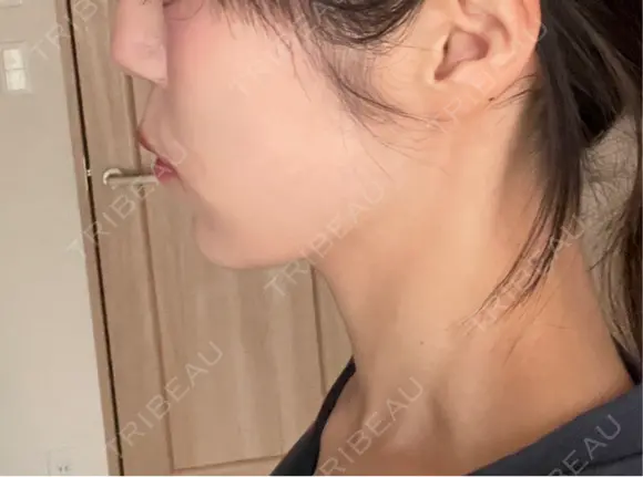 インモード TUNE CLINIC【チューンクリニック】 DAY 7 メイン用