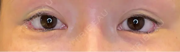 目尻切開 / タレ目形成・グラマラスライン（埋没） LOUIS CLINIC 二子玉川院【ルイクリニック】 DAY 0 メイン用