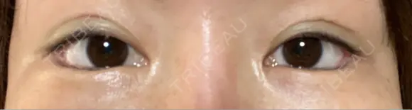 目尻切開 / タレ目形成・グラマラスライン（埋没） LOUIS CLINIC 二子玉川院【ルイクリニック】 DAY 1 メイン用