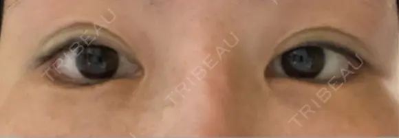 目尻切開 / タレ目形成・グラマラスライン（埋没） LOUIS CLINIC 二子玉川院【ルイクリニック】 DAY 4 メイン用