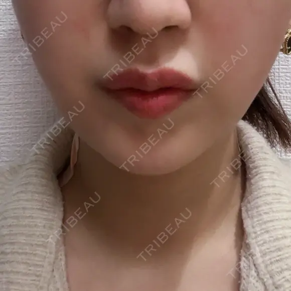 インモード BISIN GINZA CLINIC DAY 0 メイン用