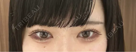 二重埋没 TCB東京中央美容外科 奈良院 AFTER メイン用