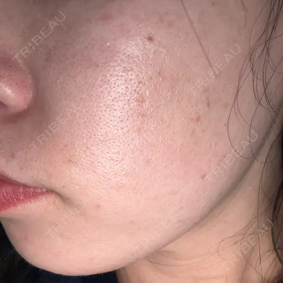 光治療（フォトフェイシャルなど） エイトビューティークリニック 新宿院 AFTER メイン用