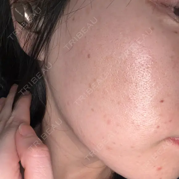 光治療（フォトフェイシャルなど） エイトビューティークリニック 新宿院 DAY 0 メイン用