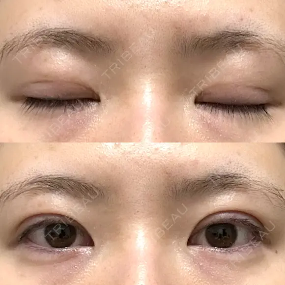 二重埋没 / 上まぶたの脂肪取り アリエル美容クリニック 郡山院 DAY 56 メイン用