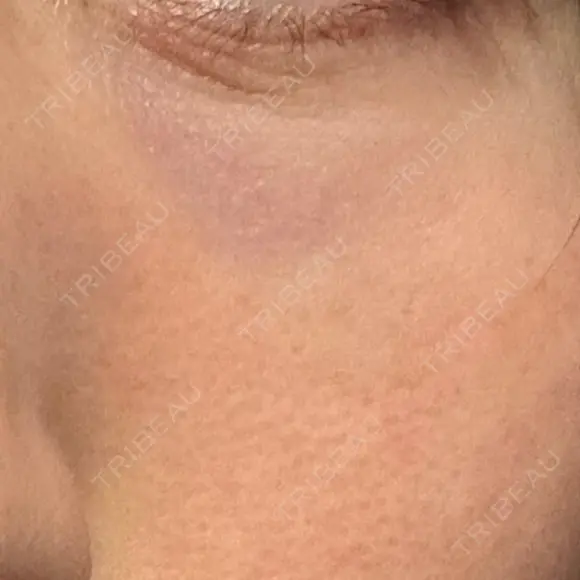 その他（目元） 品川スキンクリニック広島院 DAY 6 メイン用