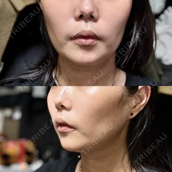 糸リフト PRISM Beauty Clinic 町田院 AFTER メイン用