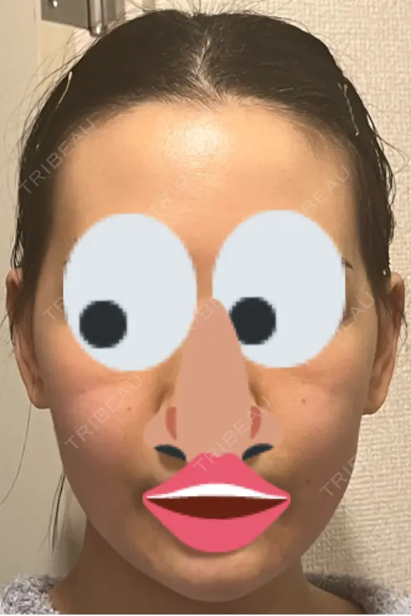 インモード PureMe Skin Clinic（ピュアミースキンクリニック麻布） DAY 0 メイン用
