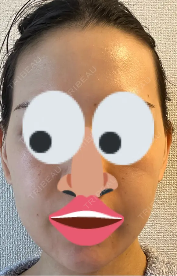 インモード PureMe Skin Clinic（ピュアミースキンクリニック麻布） DAY 1 メイン用