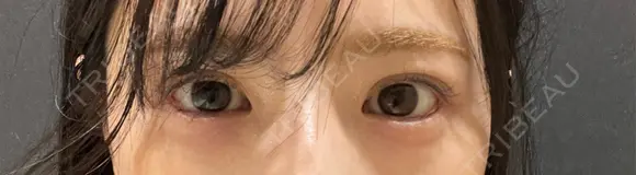 目尻切開 / タレ目形成・グラマラスライン（埋没） LOUIS CLINIC 二子玉川院【ルイクリニック】 AFTER メイン用