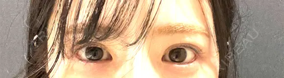 目尻切開 / タレ目形成・グラマラスライン（埋没） LOUIS CLINIC 二子玉川院【ルイクリニック】 DAY 24 メイン用