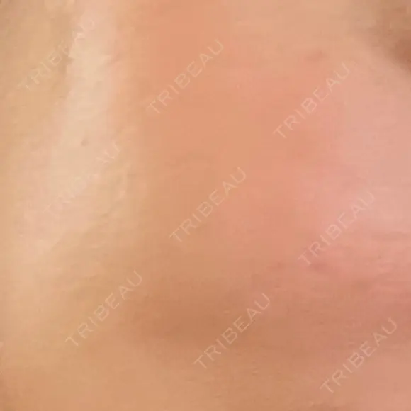 ピコスポット 東京シルククリニック 新宿院 AFTER メイン用