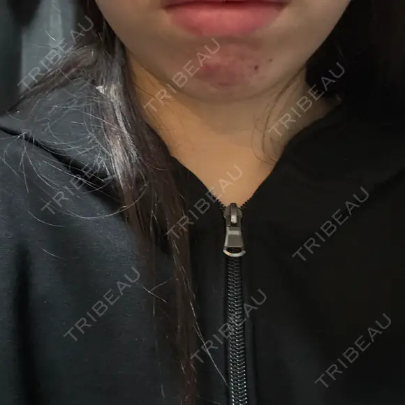 その他（肌） / RF（高周波）たるみ治療 / オンダリフト / その他（輪郭） ライブリークリニック 浜松町院 AFTER メイン用