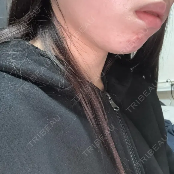 その他（肌） / RF（高周波）たるみ治療 / オンダリフト / その他（輪郭） ライブリークリニック 浜松町院 DAY 0 メイン用