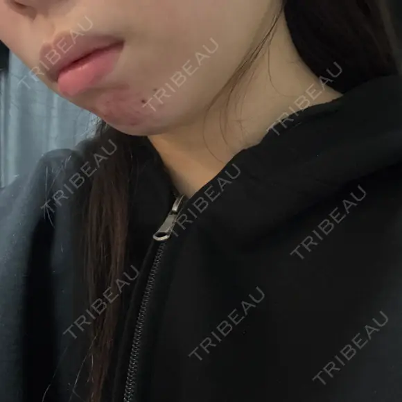 その他（肌） / RF（高周波）たるみ治療 / オンダリフト / その他（輪郭） ライブリークリニック 浜松町院 DAY 0 メイン用